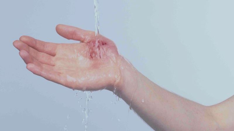 Bị cắt, xước hoặc bầm tím da