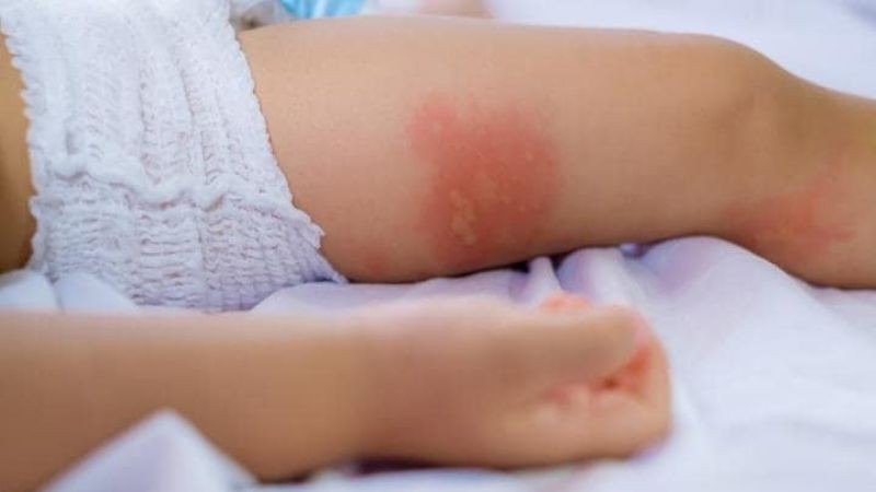 Hội chứng Skeeter do muỗi đốt