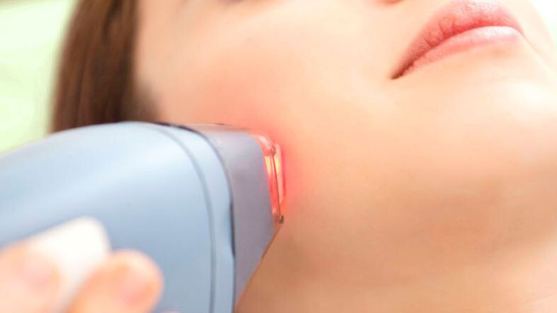 Triệt lông bằng laser